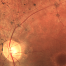 Diabetic Retinopathy