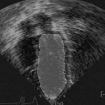 Heart Analysis