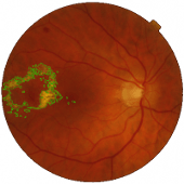 Exsudates shapes in overlay of color fundus image