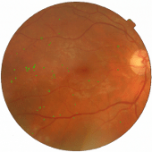 Microaneurysms shapes in overlay of color fundus image