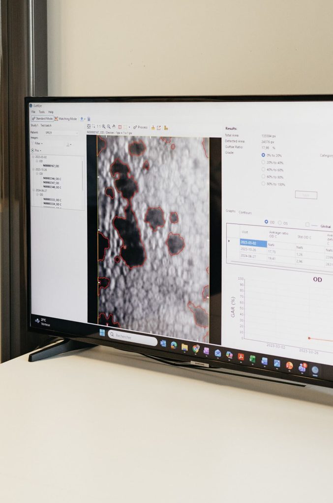 ADCIS_computer_vision_AI_Software_Ophtalmo_monitor_disease