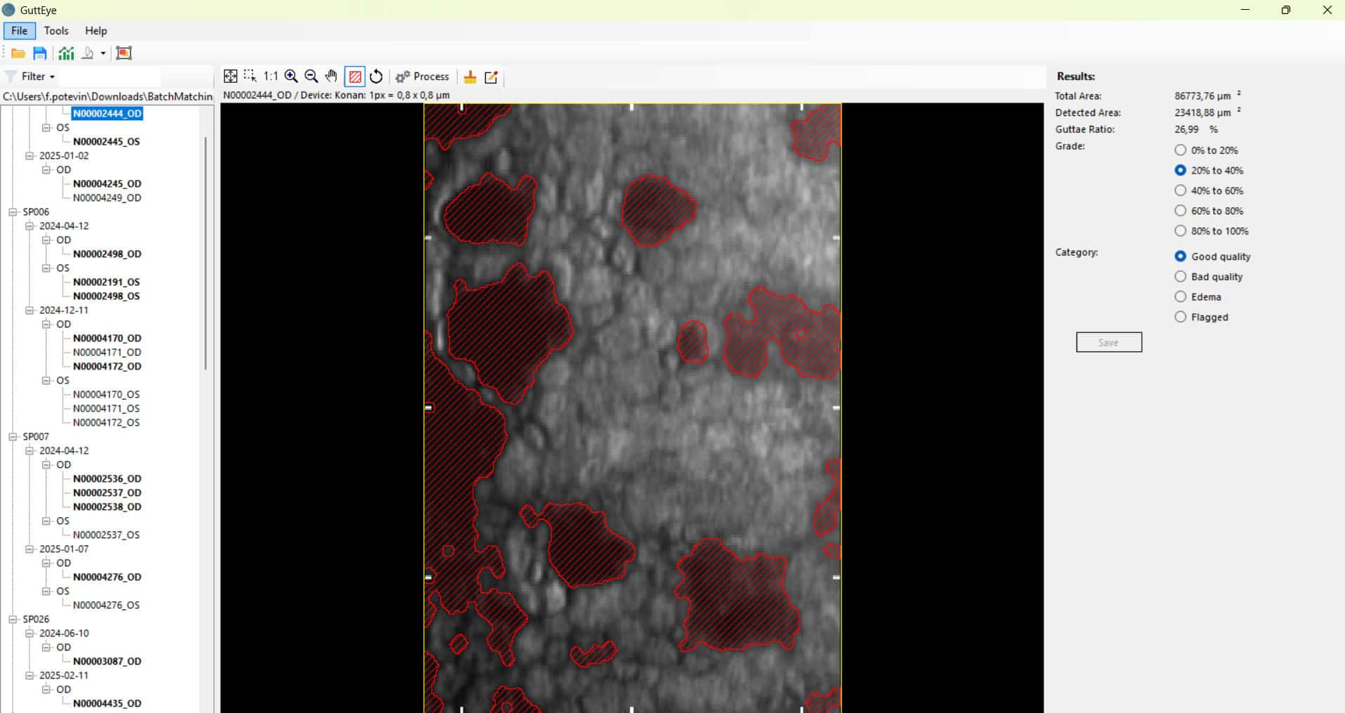 Gutteye automatically segments guttae in specular microscopy imaging to support a sensitive FECD grading and its longitudinal tracking