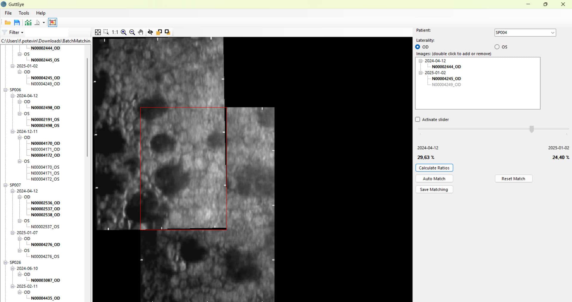 Automatic image allignement : Since guttas are not evenly distributed across the cornea, it is essential to be able to compare the evolution of the GAR% FECD score over time in common cellular areas.