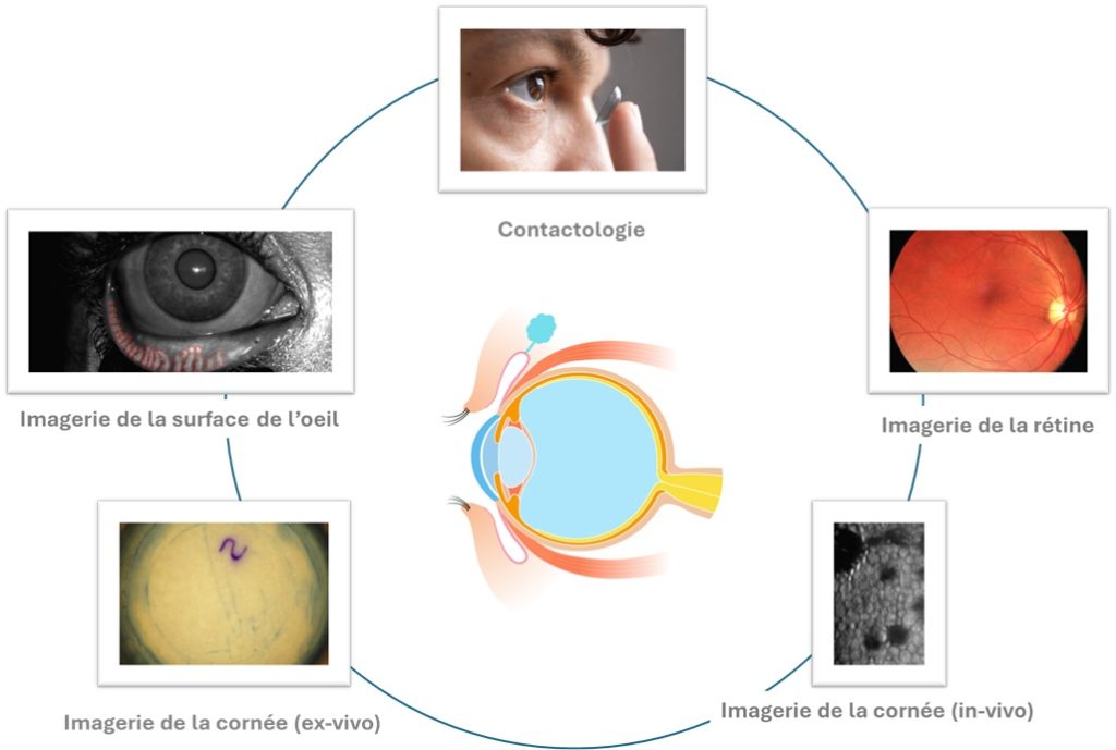 L'expertise d'ADCIS en ophtalmologie porte sur le traitement et l'analyse d'images de rétines, de cornées et de la surface de l'oeil