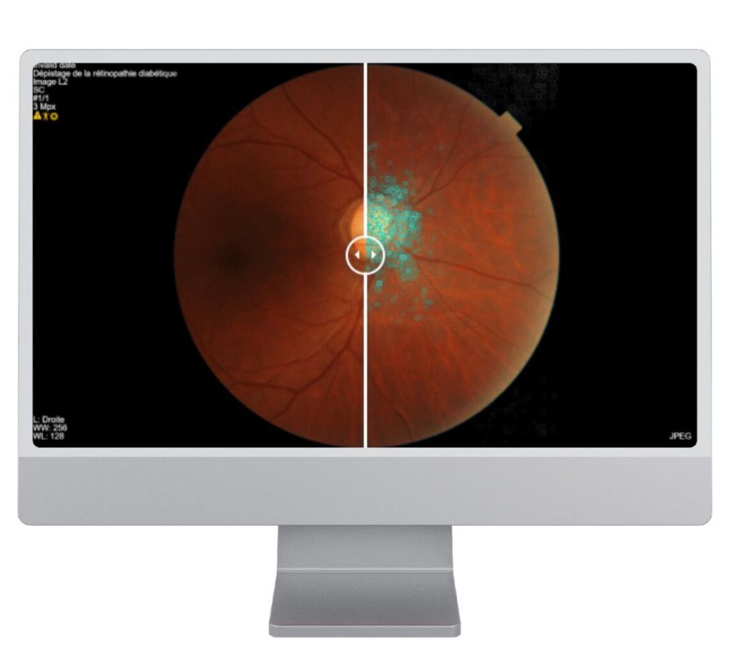 ADCIS_computer_vision_AI_Software_key_benefit_OphtAI
